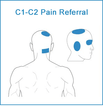 Facet-Pain-C1-C2