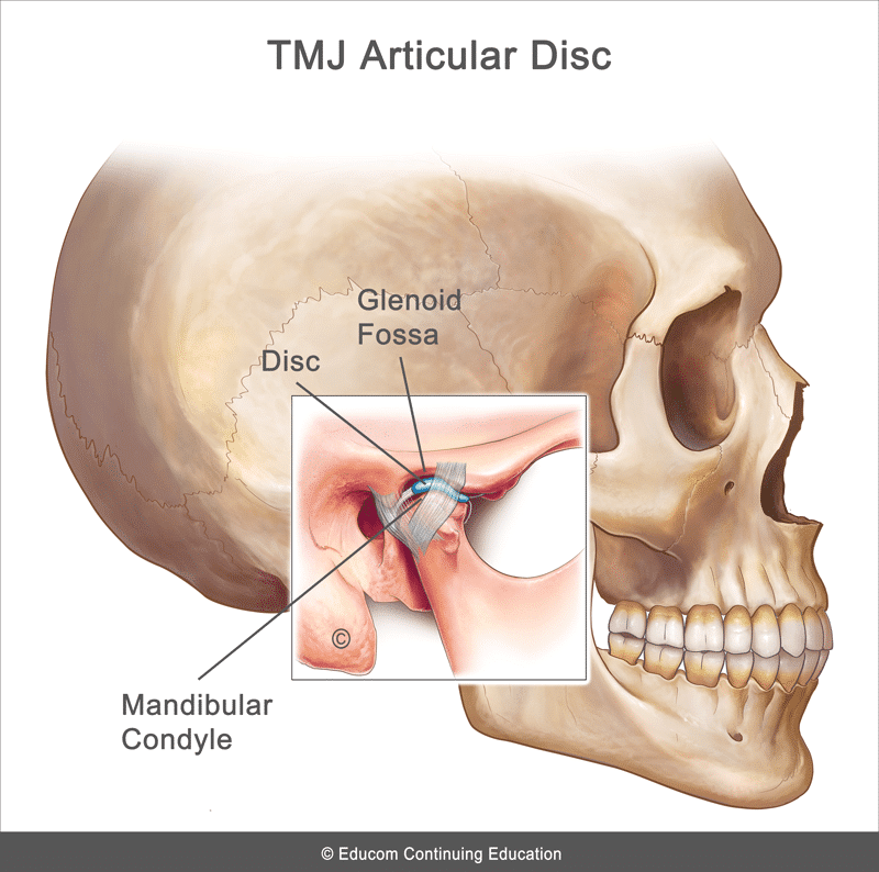 TMJ-Disc