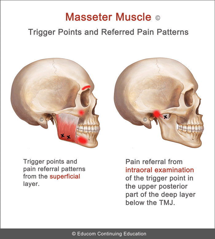 masseter-TrPts