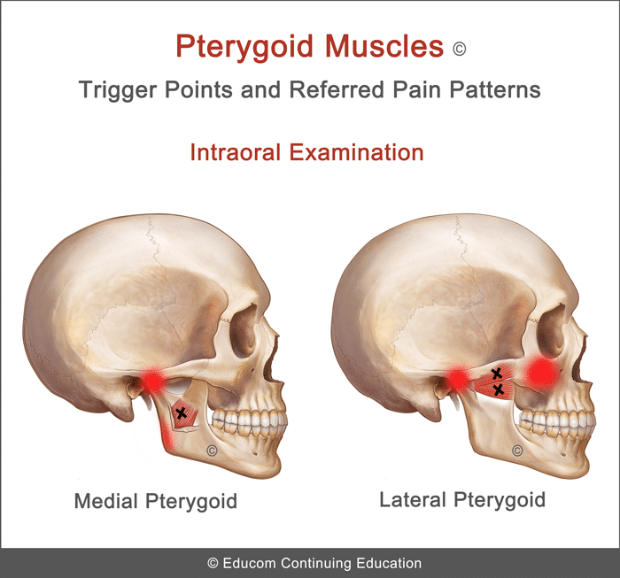 pterygoid-TrPts